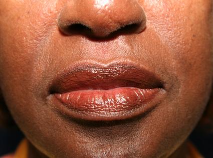 lip-procedure-before