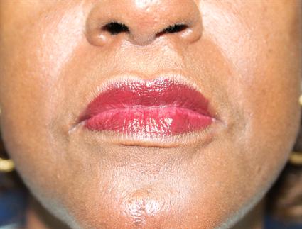 LIP REDUCTION 315