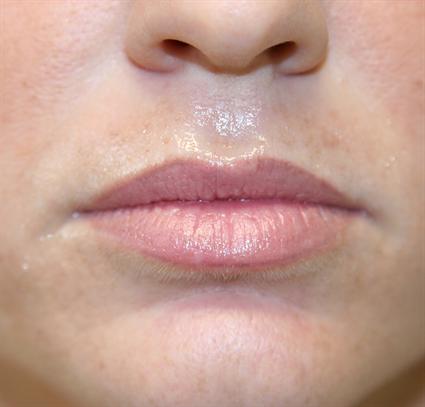 before-lip-procedure