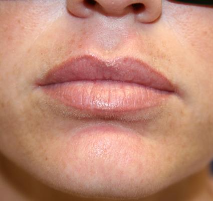 LIP AUGMENTATION 316