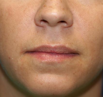 before-lip-filler