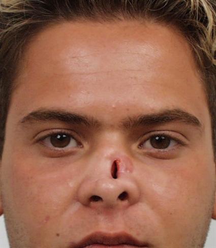before male corrective surgery