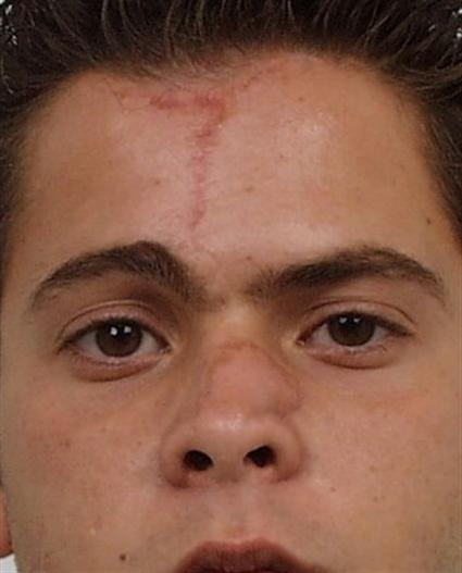 CORRECTIVE NOSE SURGERY 324