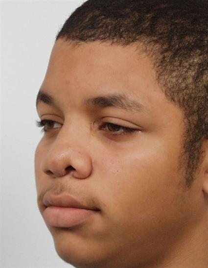 before nose corrective surgery
