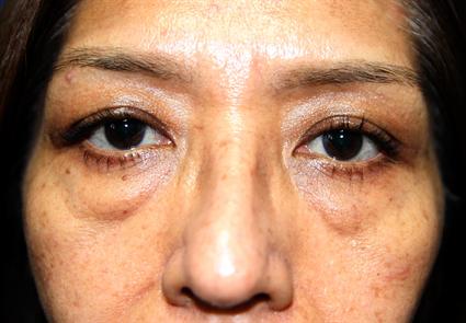 eyelid-surgery-blepharoplasty-before