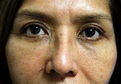 EYELID SURGERY- BLEPHAROPLASTY CASE 331
