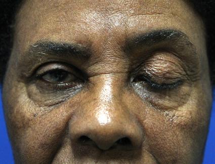 male-eyelid-ptosis-repair-before