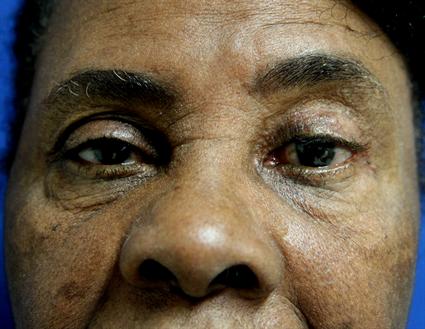 EYELID PTOSIS REPAIR CASE 332