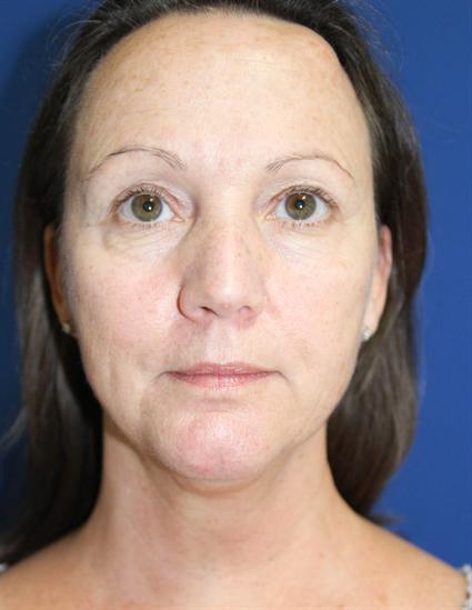 chemical-peels-before