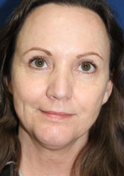 CHEMICAL PEELS CASE 333