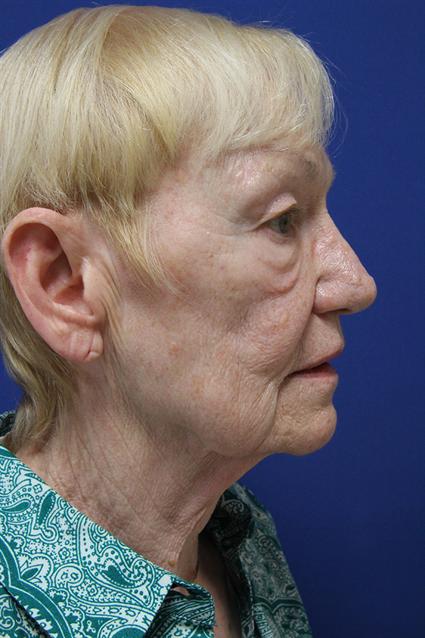 face-lift-and-neck-lift
