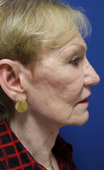 FACE LIFT AND NECK LIFT CASE 334