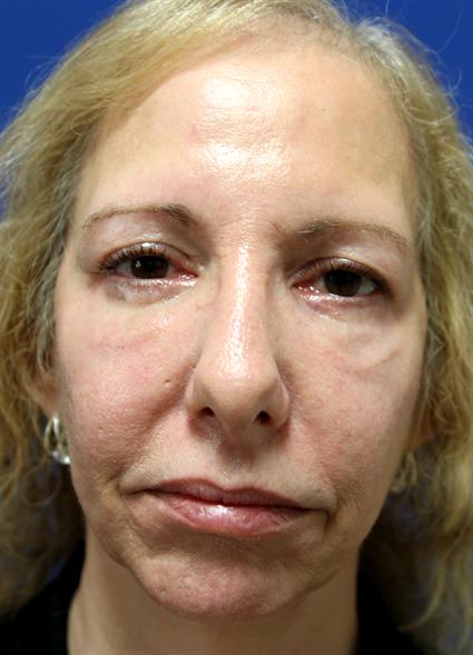 FACIAL, CHEEK IMPLANTS CASE 336