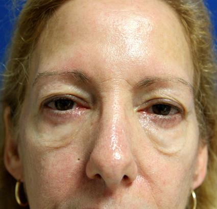 before-facial-cheek-implants