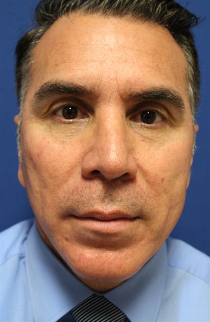 FACIAL, CHIN IMPLANTS CASE 337