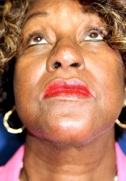 FACIAL, CHIN IMPLANTS CASE 338