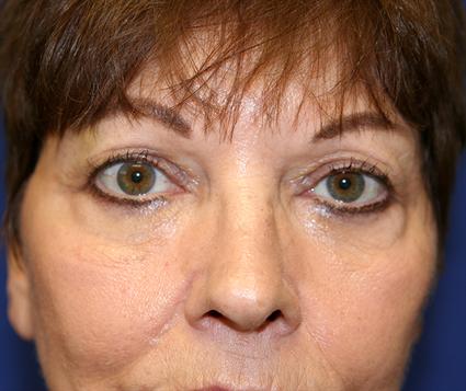 facial-fat-graft-before