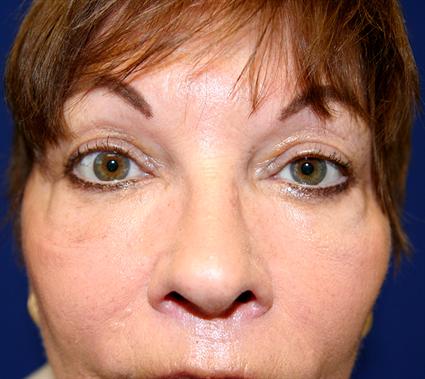 FACIAL FAT GRAFTS CASE 341