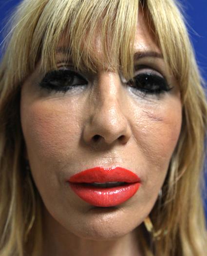 FACIAL FAT GRAFTS CASE 342