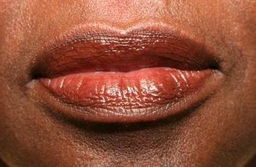 lip-procedure-before