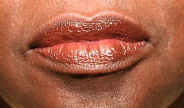 LIP PROCEDURES CASE 351