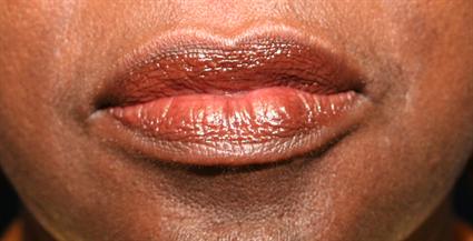 LIP PROCEDURES CASE 351