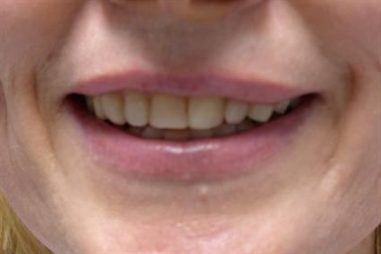 LIP PROCEDURES CASE 352