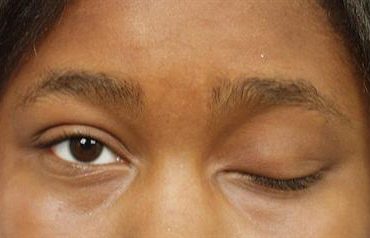 eyelid-ptosis-repair-before