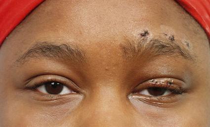 EYELID PTOSIS REPAIR CASE 360