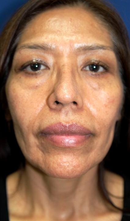 face-lift-and-neck-lift