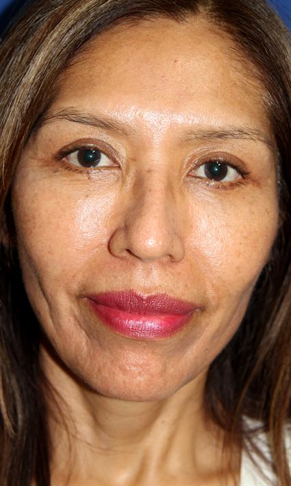 FACE LIFT AND NECK LIFT CASE 361