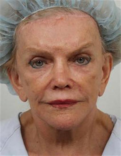 face-lift-and-neck-lift-before