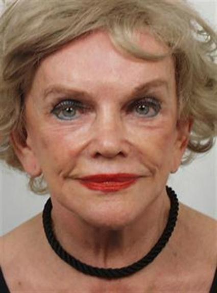 FACE LIFT AND NECK LIFT CASE 362