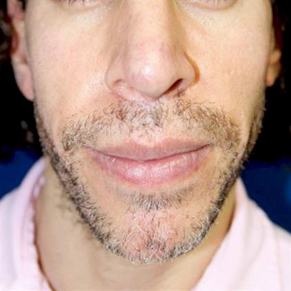 before-facial-cheek-implants