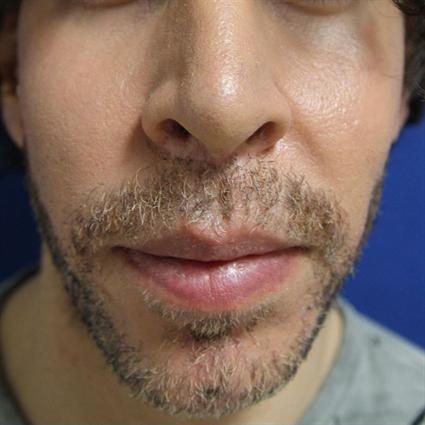 CHEEK IMPLANTS 382
