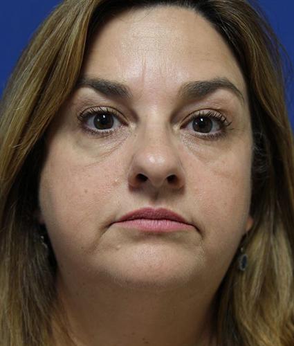eyelid-surgery-blepharoplasty-before