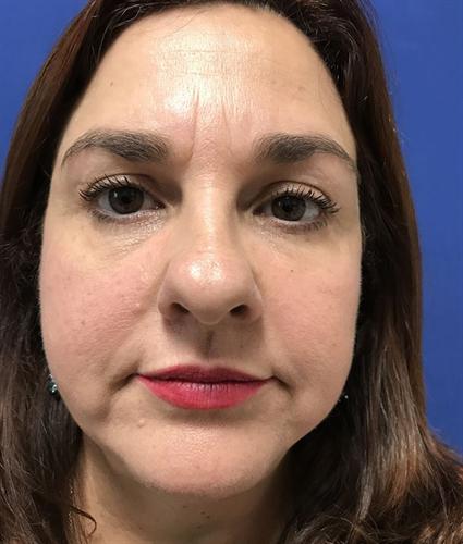 FACE LIFT AND NECK LIFT CASE 383