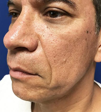 before male chin facial implants