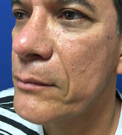 CHIN IMPLANTS AND NOSE TIP SURGERY 401