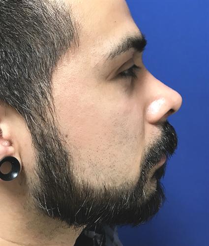 RHINOPLASTY 402