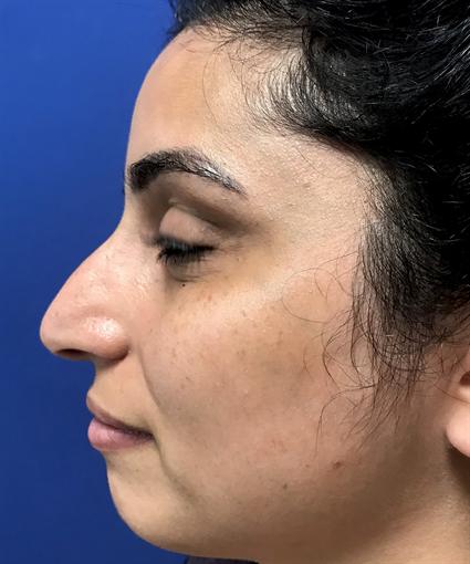 before nose corrective surgery