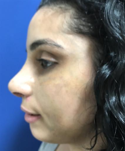 RHINOPLASTY - NOSE SURGERY 404