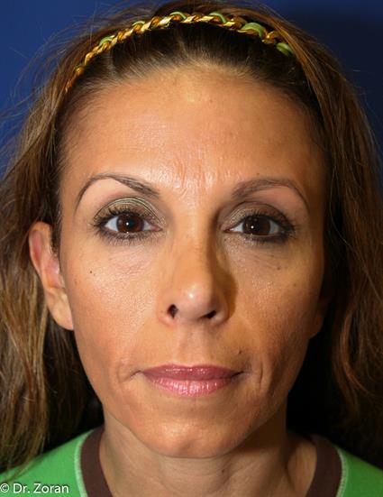before nose corrective surgery