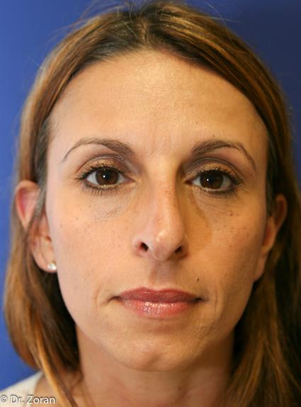 RHINOPLASTY 5