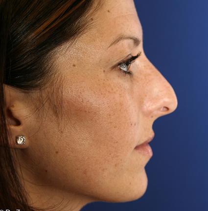 before corrective nose surgery