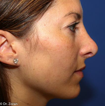 RHINOPLASTY - NOSE SURGERY 59