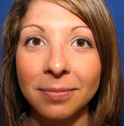 before female rhinoplasty