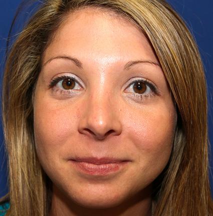 RHINOPLASTY - NOSE SURGERY 60