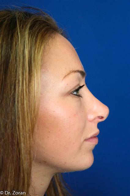 RHINOPLASTY SURGERY UNDER LOCAL ANESTHESIA?