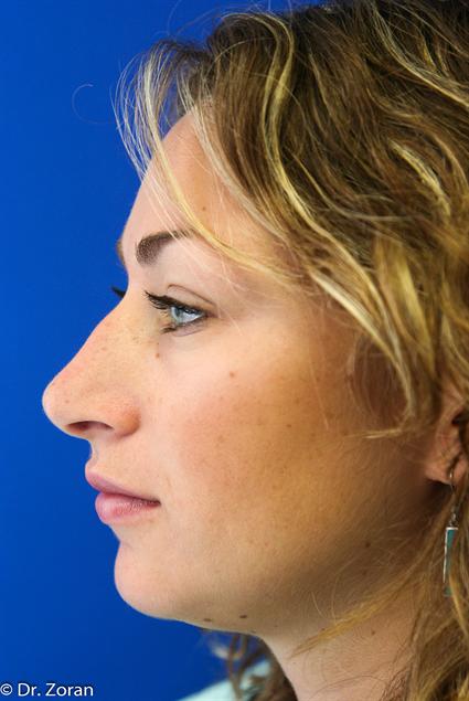facial-fat-graft-before